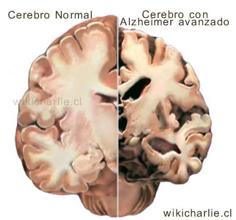Cerebro Alzheimer.png
